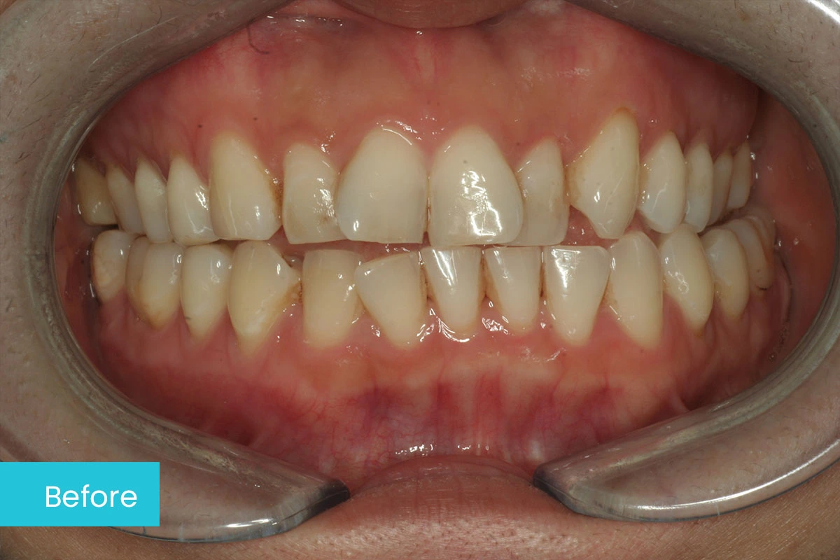 Invisalign 1 Before