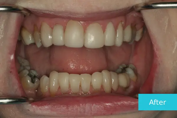 Invisalign After