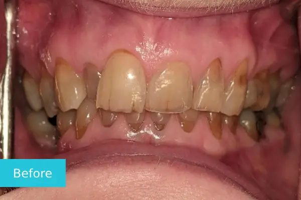 Invisalign Before