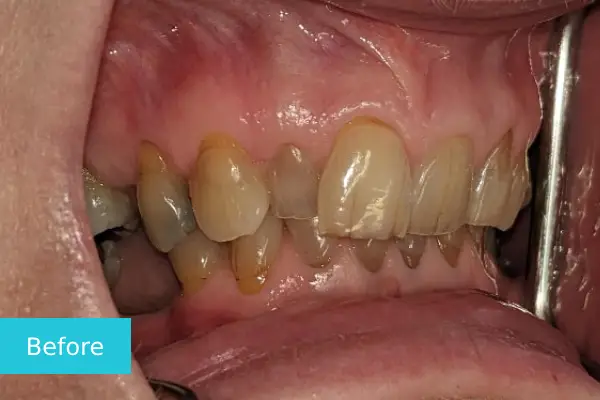 Invisalign Before