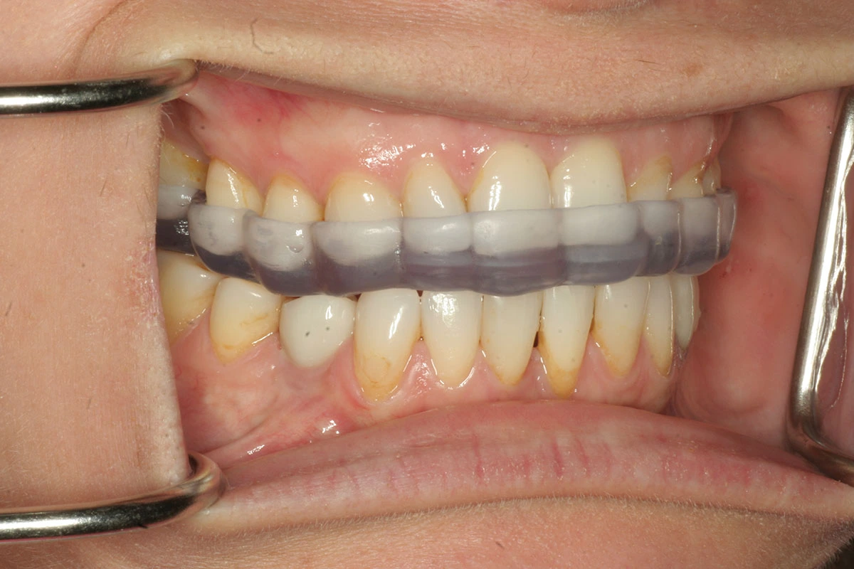 Michigan Splint