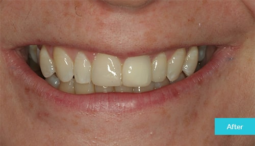 Invisalign After