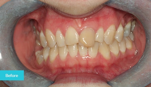 Invisalign Before