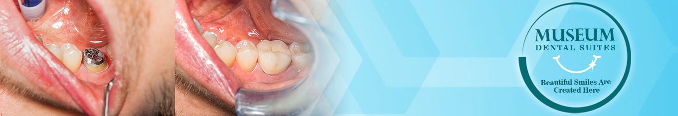 Dental Crowns