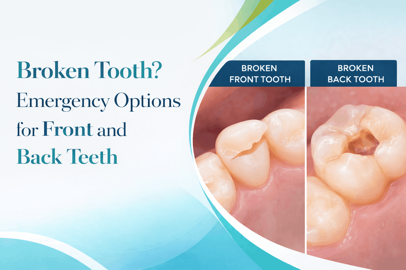 Broken Tooth? Emergency Options for Front and Back Teeth