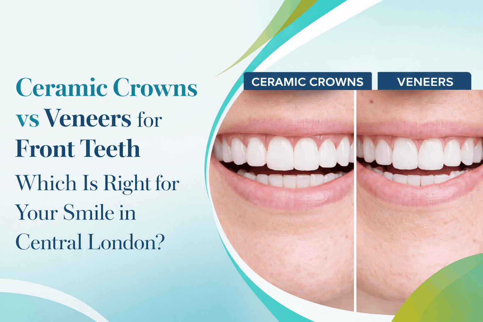 Ceramic Crowns vs Veneers for Front Teeth – Which Is Right for Your Smile in Central London?