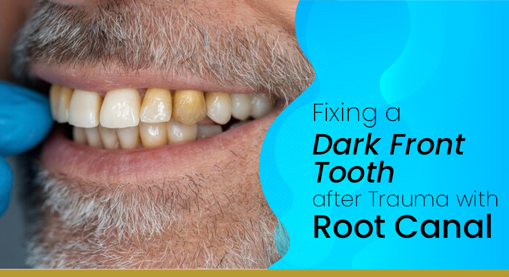 Fixing a Dark Front Tooth After Trauma with Root Canal, Internal Whitening Invisalign® and Composite Veneer in Holborn