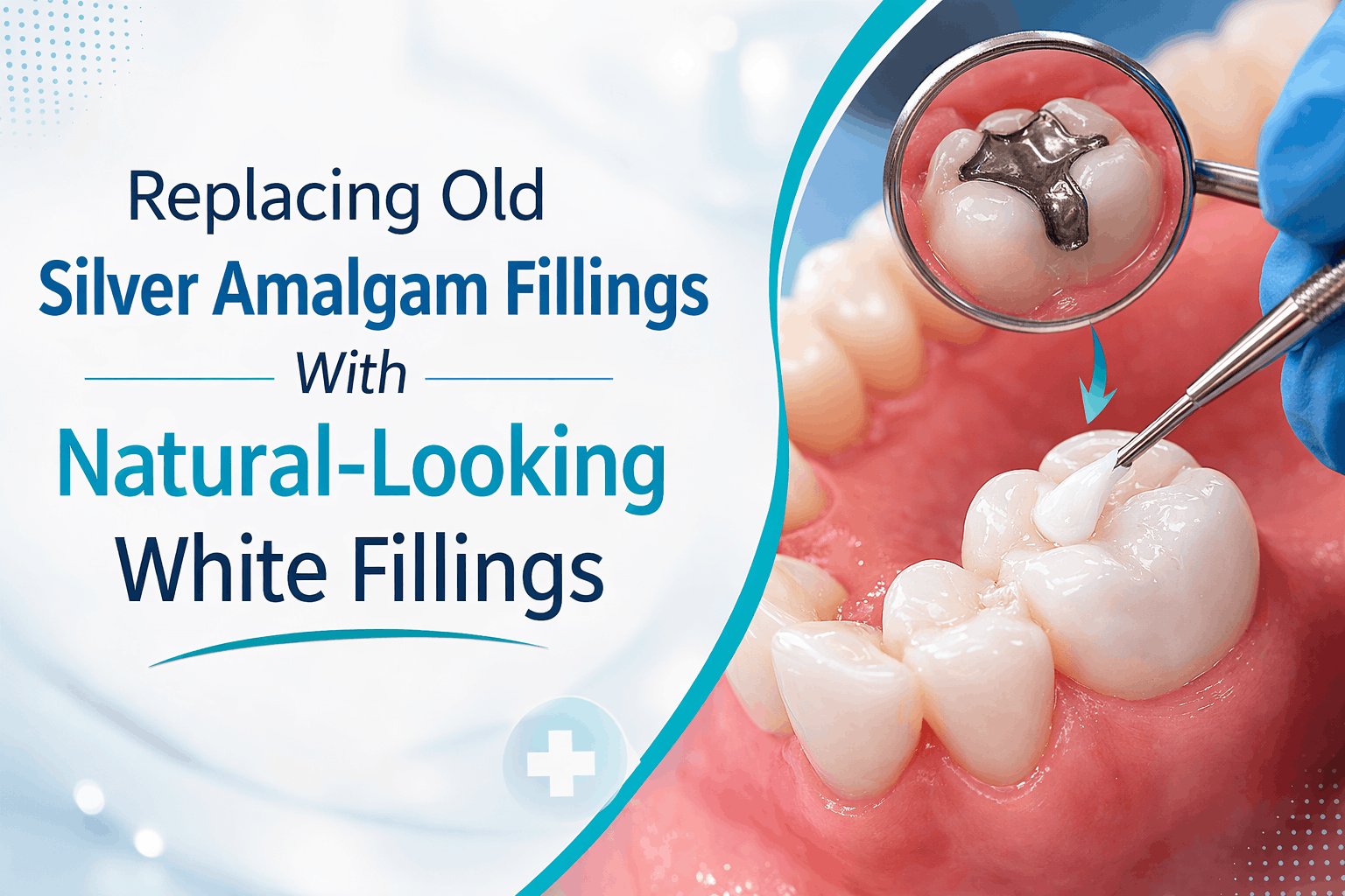 Replacing Old Silver Amalgam Fillings With Natural-Looking White Fillings