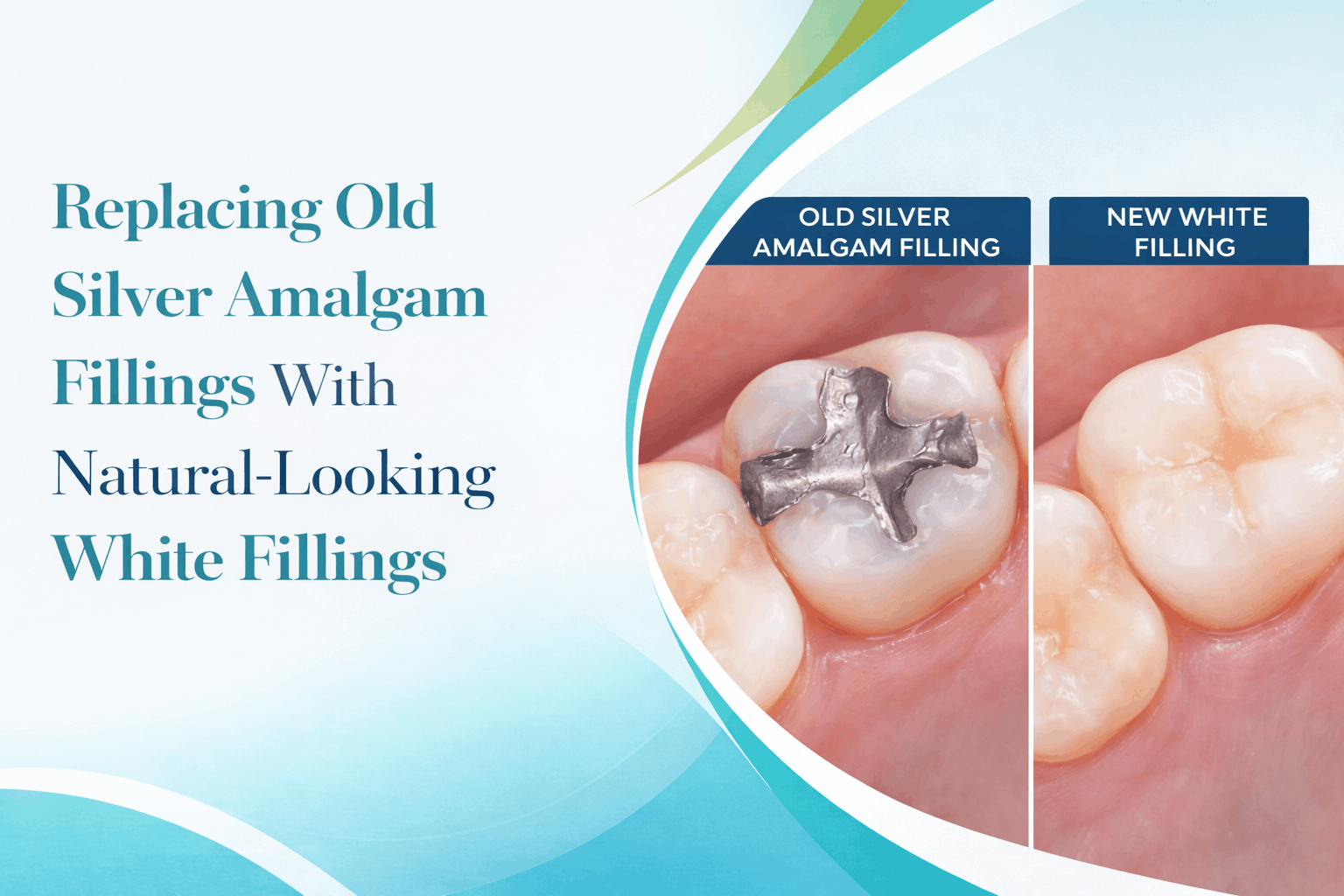 Replacing Old Silver Amalgam Fillings With Natural-Looking White Fillings