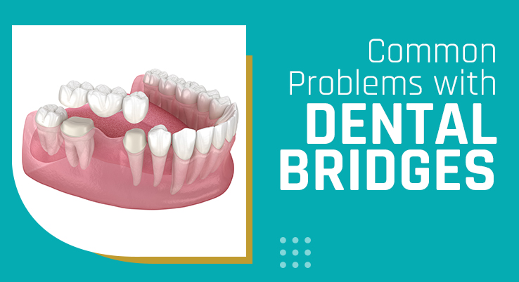 Common Problems with Dental Bridges You Shouldn’t Overlook