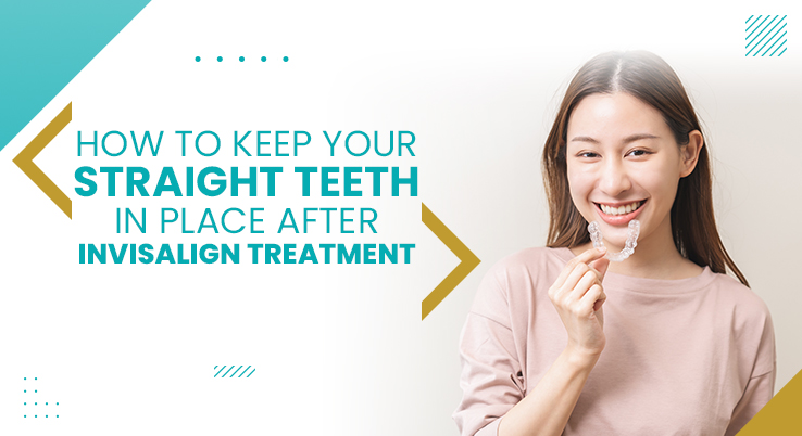 How to Keep Your Straight Teeth in Place after Invisalign Treatment