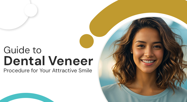 Guide to Dental Veneer Procedure for Your Attractive Smile