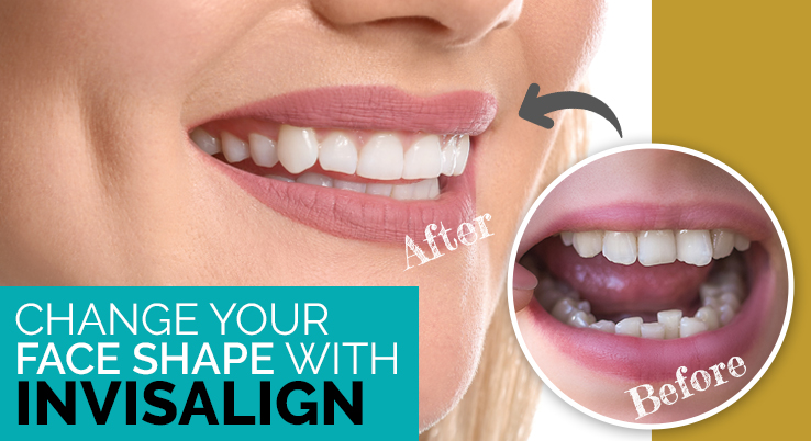 How can Braces and Invisalign Change Your Facial Shape?