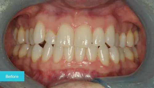 1597998019117Invisalign-london-before
