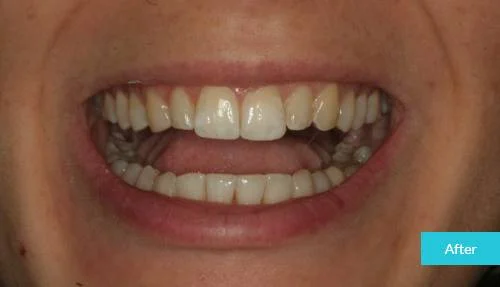 1597998019143Invisalign-after-1