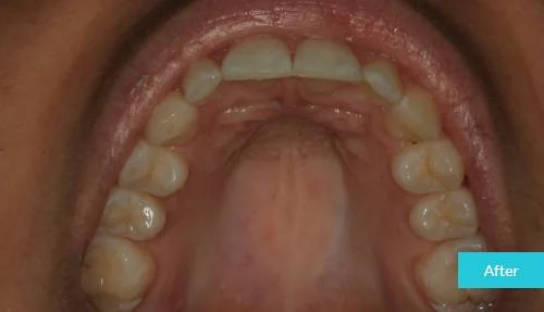 1597998019550invisalign-after-2