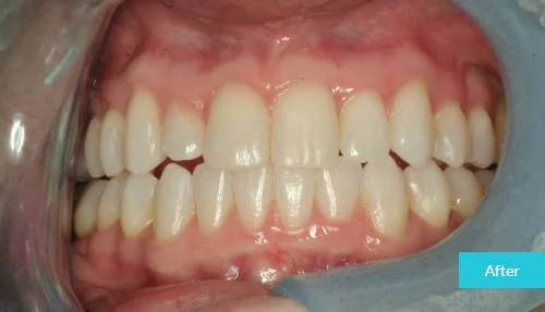 1597998019569Invisalign-London-after