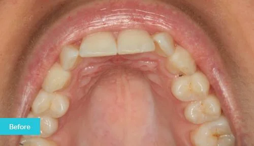 1597998019673invisalign-before-2