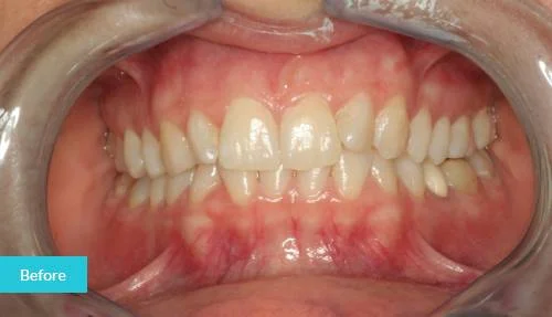 1597998019903Invisalign-before-1