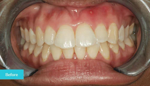 Invisalign-London-contouring-before