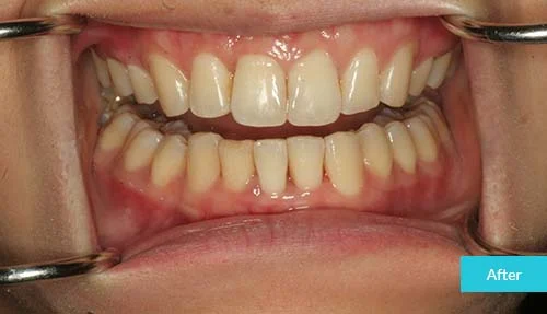 Invisalign-after-4