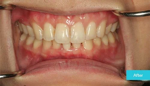Invisalign-after-5