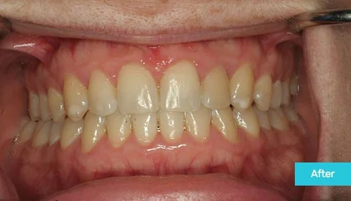 Invisalign-after-gapped-teeth