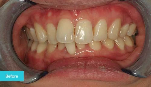 Invisalign-before-5