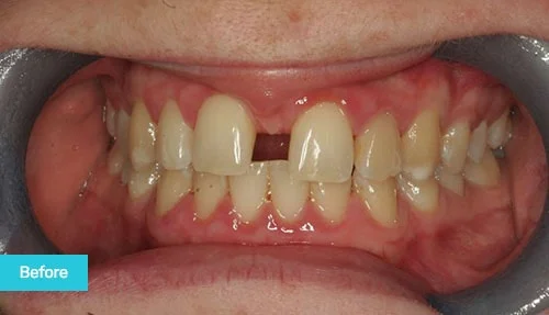 Invisalign-before-gapped-teeth