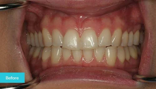 Teeth-whitening-bonding-before1