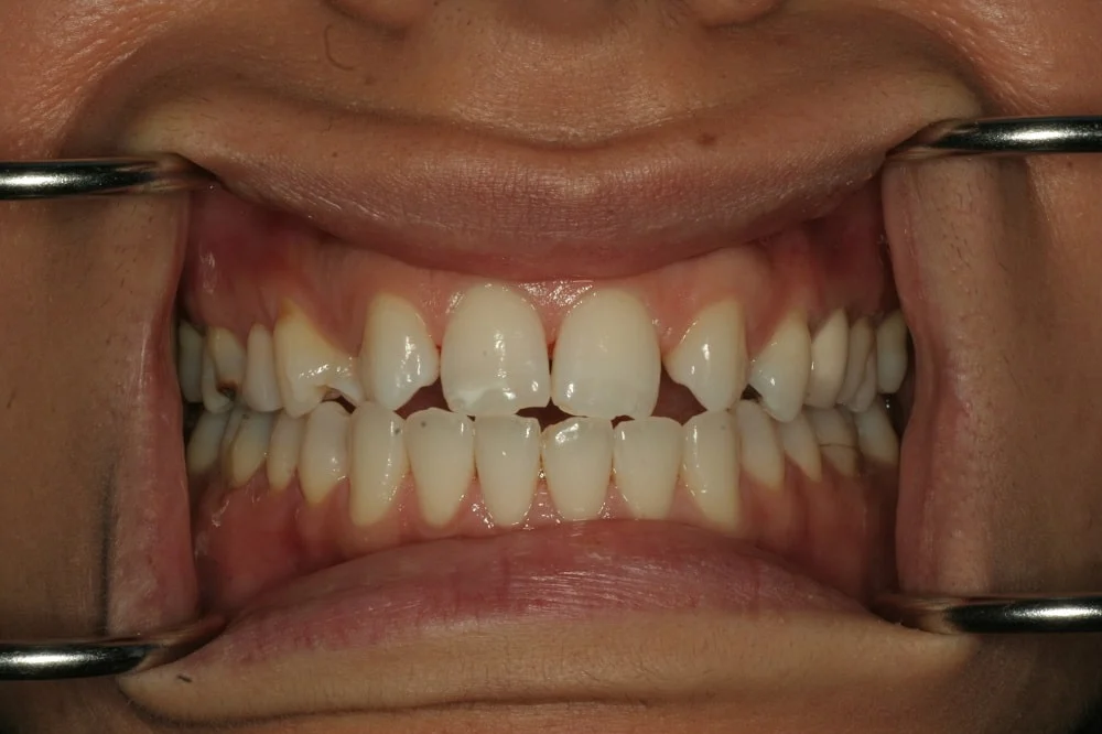 amazing-case-of-invisalign01