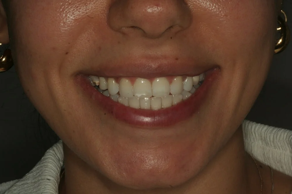 amazing-case-of-invisalign02