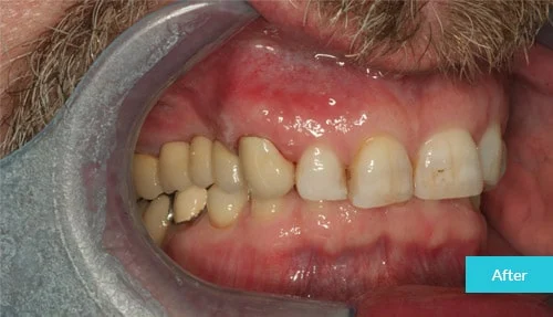 case14-after