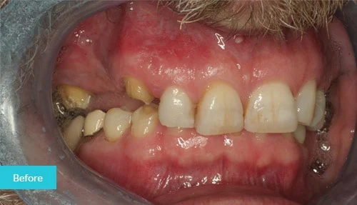 case14-before