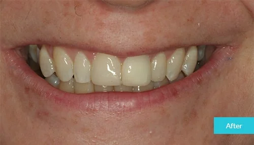 case2-after
