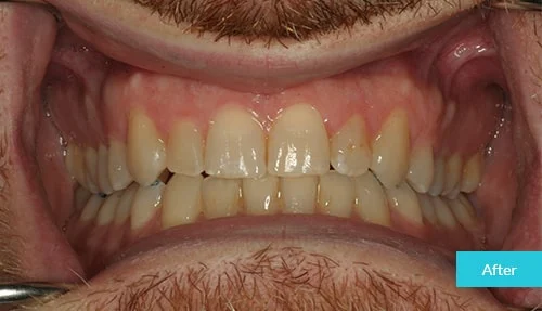 full-invisalign-after