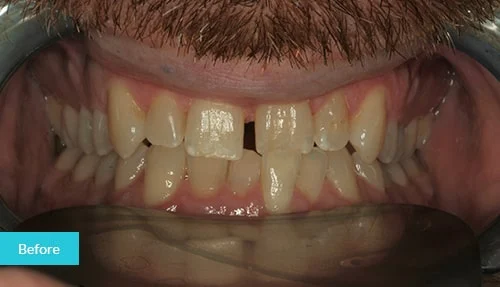 full-invisalign-before