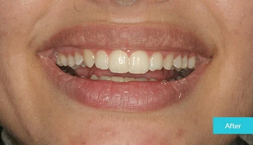 full-invisalign2-after