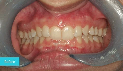 full-invisalign2-before