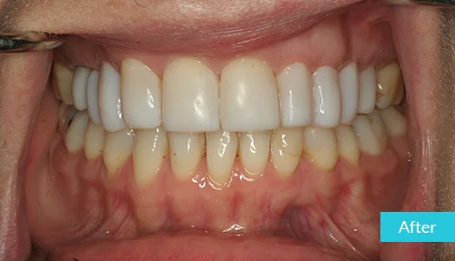 full-upper-set-after