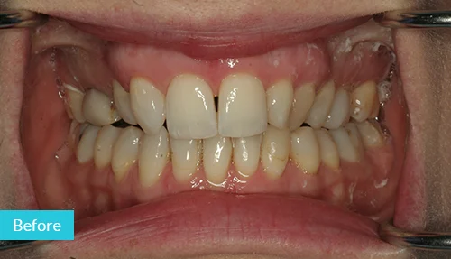 full-upper-set-before