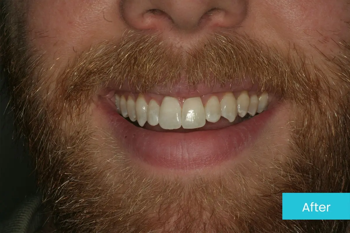 invisalign-2-after-msd