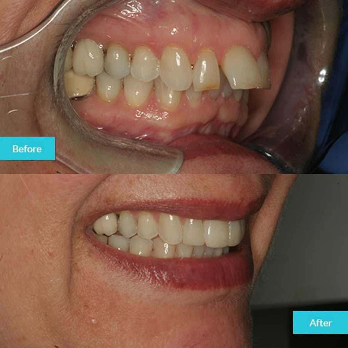 invisalign-5