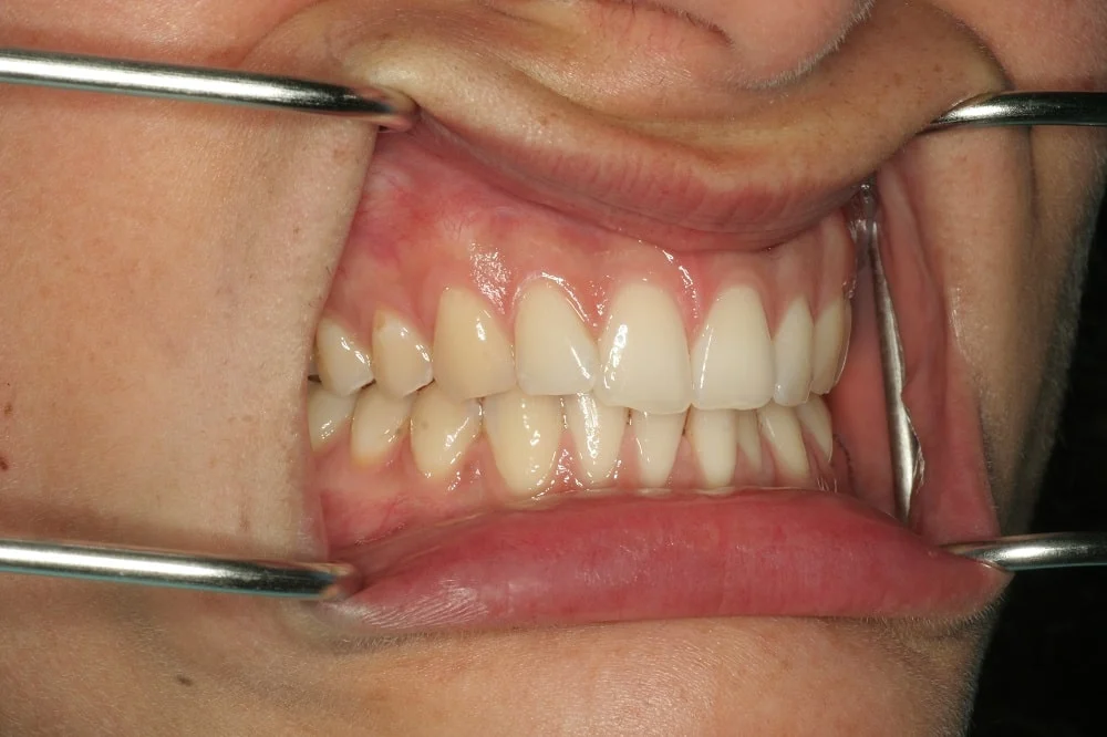 invisalign-Lite-and-whitening-case02
