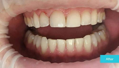 invisalign-af3ter-6