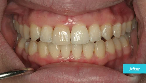 invisalign-and-contouring-after1