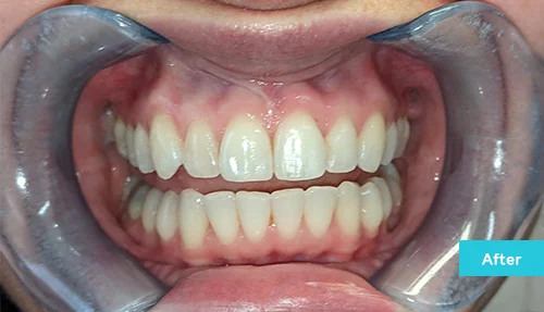 invisalign-and-contouring-after2