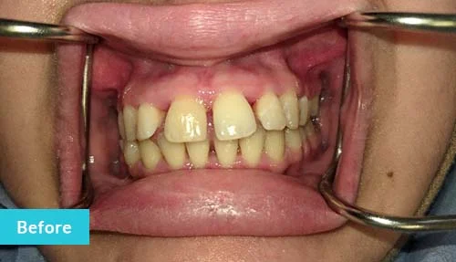 invisalign-and-contouring-before1