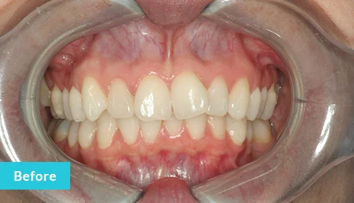 invisalign-and-contouring-before2
