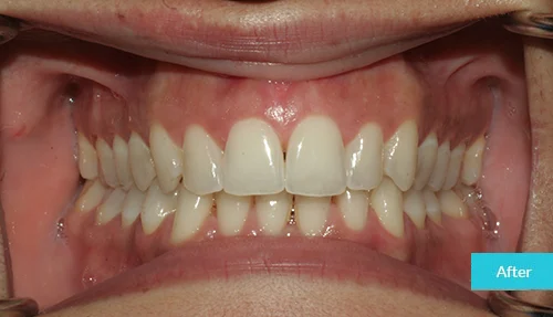 invisalign-and-teeth-whitening-after